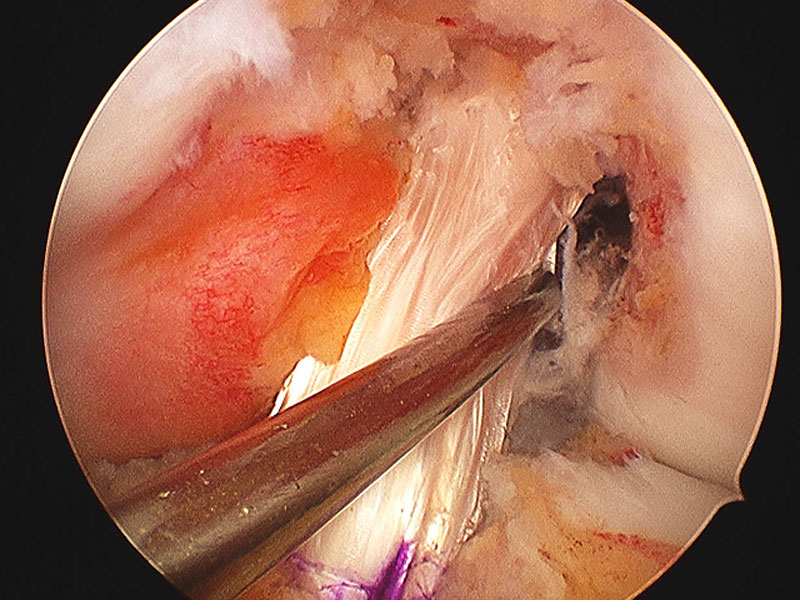 image of Anterior Cruciate Ligament (ACL )reconstruction performed by Mr. Aslam Mohammed with a four strand hamstring  knee sports injuries consultant Mr Aslam Mohammed 25 years experience in treating meniscal tears in high level atheltics   knee injuries